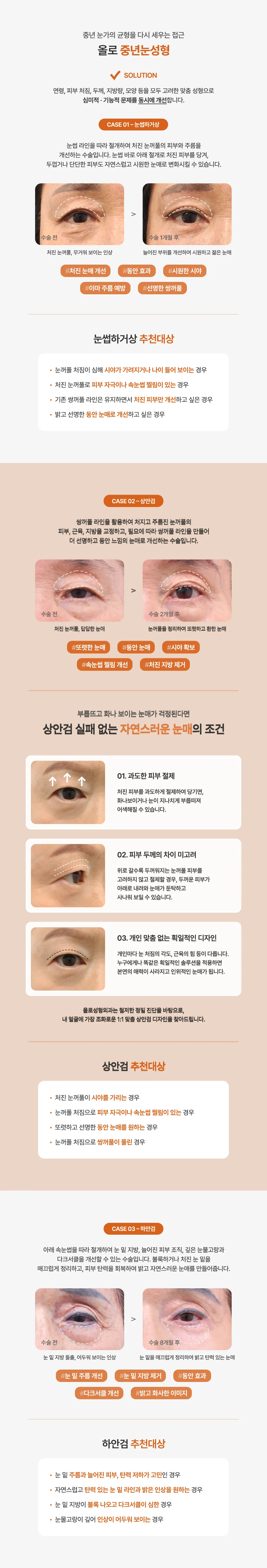 올로 중년눈성형 수술방법